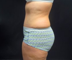 Manhattan abdominoplasty after 19